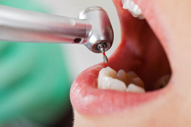 Best Emergency Root Canal Treatment in Minonk, IL